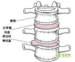 坐骨神经痛