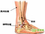 踝部急性韧带损伤