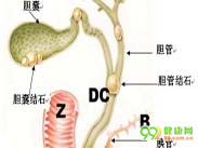 胆管结石